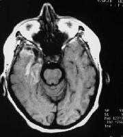 Hhv 6 Encephalitis Mri