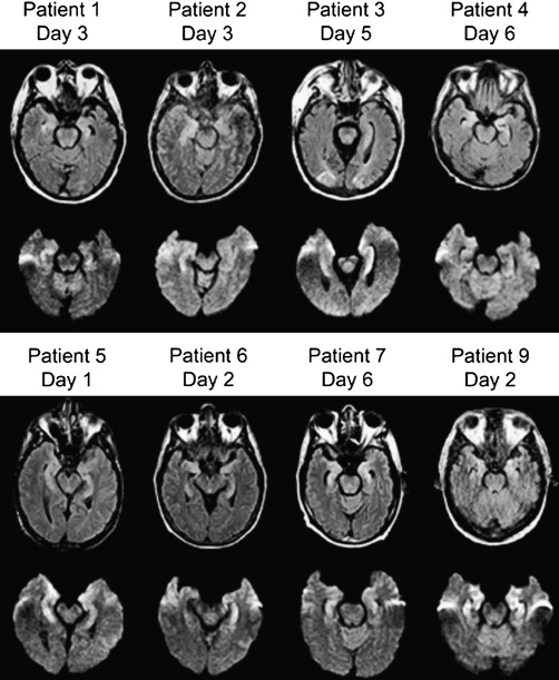 Hhv 6 Encephalitis Mri