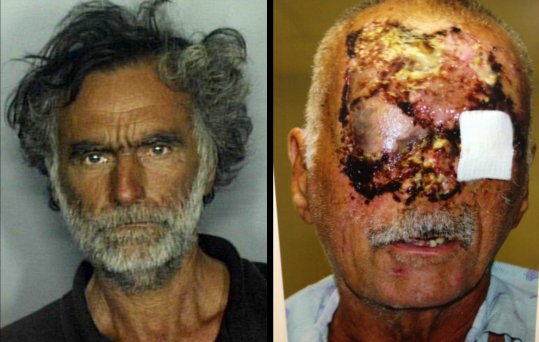 Homeless Man Face Eaten Picture