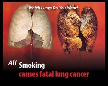 Hookah Smokers Lungs