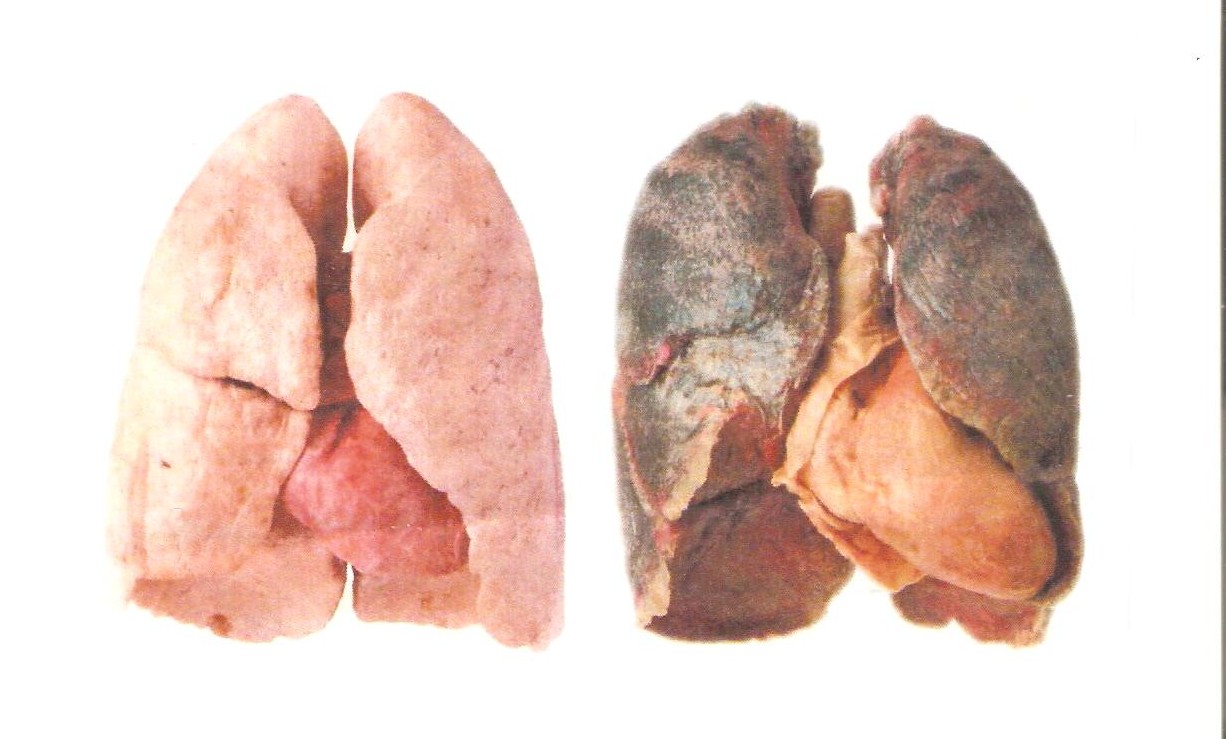 Hookah Smokers Lungs