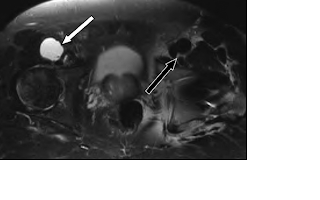 Iliopsoas Bursa Mri