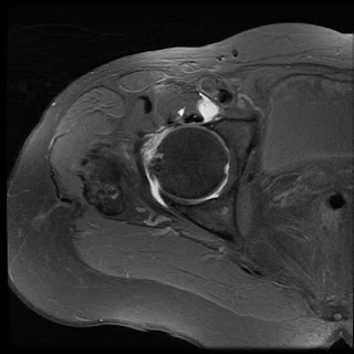 Iliopsoas Bursa Mri