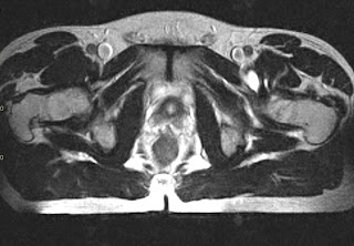 Iliopsoas Bursitis Ct