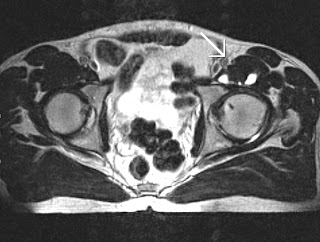 Iliopsoas Bursitis Mri Radiographics