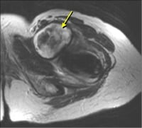 Iliopsoas Bursitis Mri Radiographics