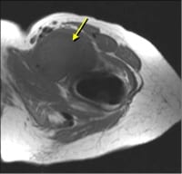 Iliopsoas Bursitis Ultrasound