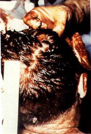 Jfk Assassination Autopsy Photos