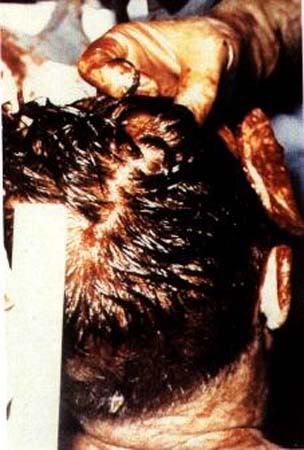 Jfk Autopsy Photos Conspiracy