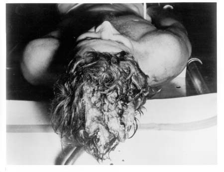 Jfk Autopsy Pictures