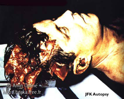 Jfk Shot Brain