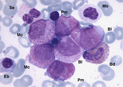 Jmml Leukemia