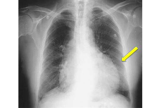 Jugular Vein Distention Left Sided Heart Failure