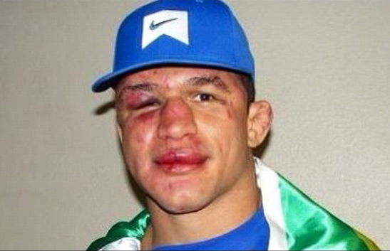 Junior Dos Santos Face After Ufc 155