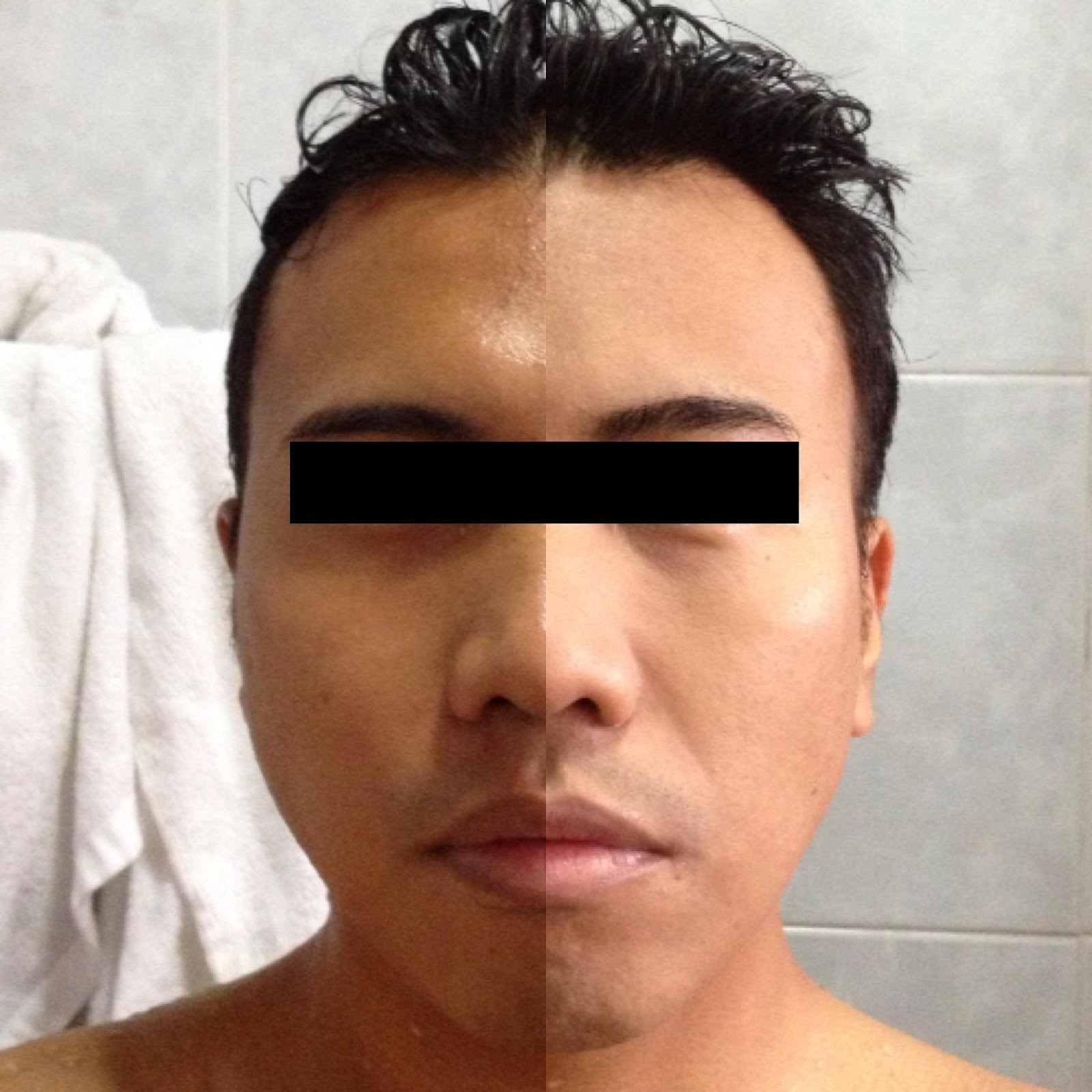 Kojic Acid Soap Results