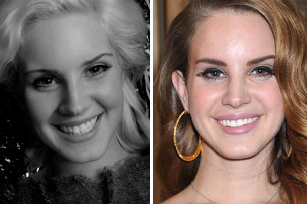 Lana Del Rey Before And After Surgery