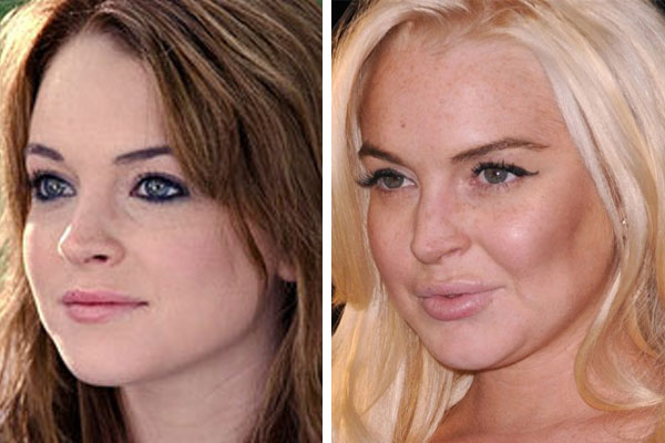 Lindsay Lohan Before And After Plastic Surgery 2012