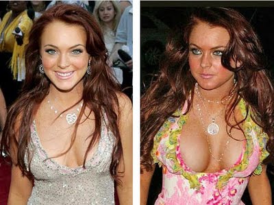 Lindsay Lohan Before And After Surgery