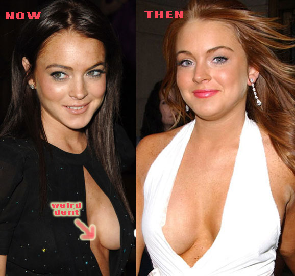 Lindsay Lohan Before And After Surgery