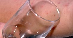 Meningitis Baby Glass Test