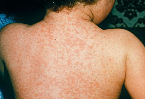 Meningitis Baby Rash