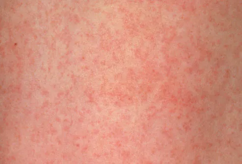 Meningitis Baby Rash