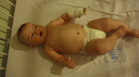 Meningitis Baby Rash Pictures