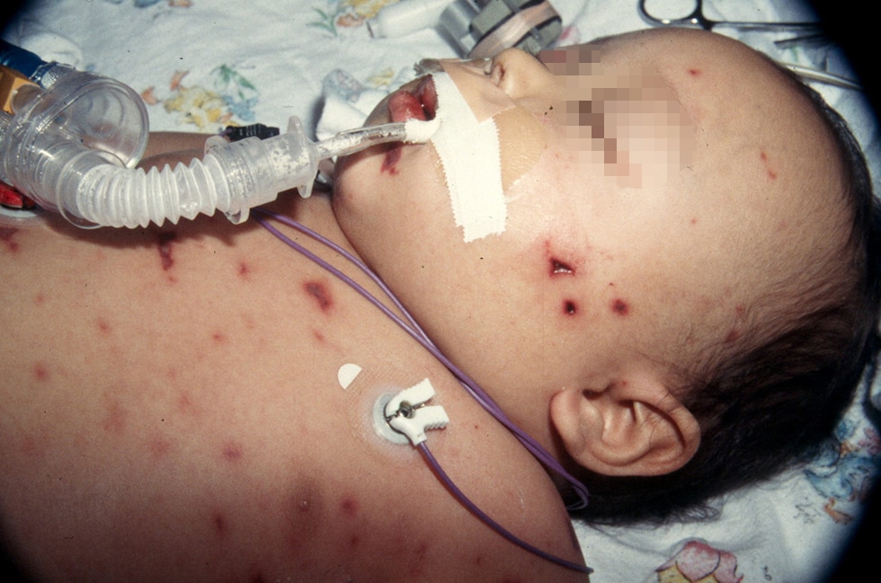 Meningitis Baby Rash Pictures