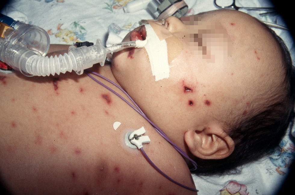 Meningitis Rash Baby