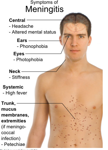 Meningitis Rash Baby Pictures