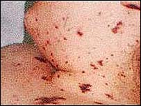 Meningitis Rash Early Stages