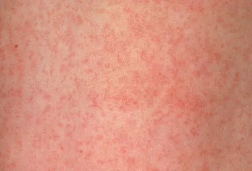 Meningitis Symptoms Rash Pics