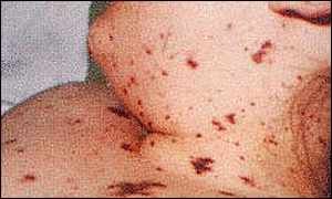 Meningitis Symptoms Rash Pics