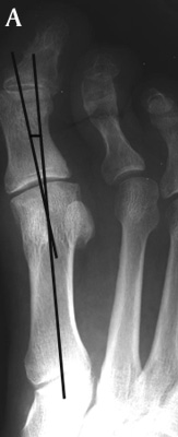 Normal Hallux Valgus Angle