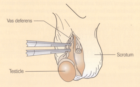 Testicles Removed Prostate Cancer