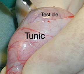 Testicles Removed Video
