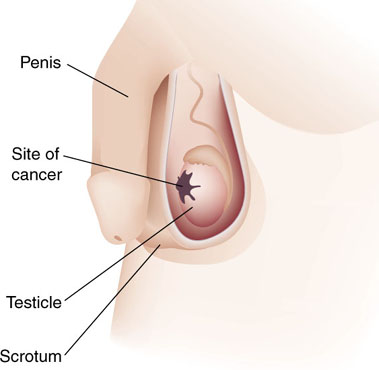 Testicular Cancer Lump Shape