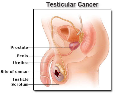 Testicular Cancer Lump Shape