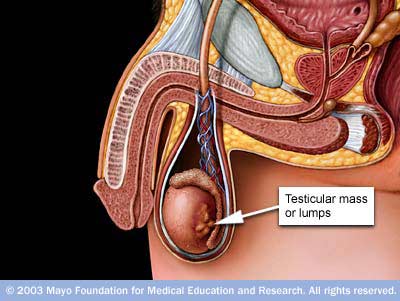 Testicular Cancer Lump Shape