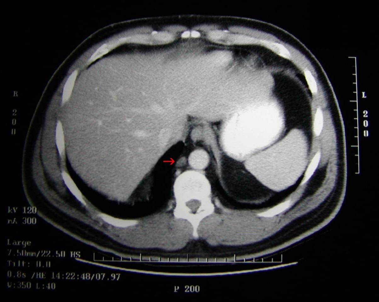 Testicular Cancer Lump Size