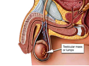 Testicular Cancer Pictures Of Lumps