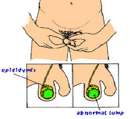 Testicular Cancer Pictures Of Lumps