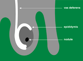 Testicular Cancer Signs And Symptoms