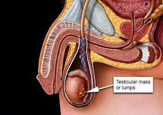 Testicular Cancer Symptoms Wiki