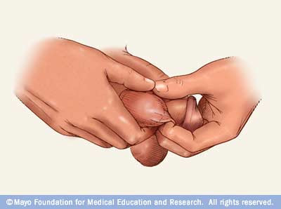 Testicular Cancer Symptoms Yahoo