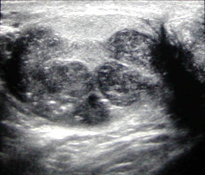 Testicular Cancer Ultrasound Diagnosis