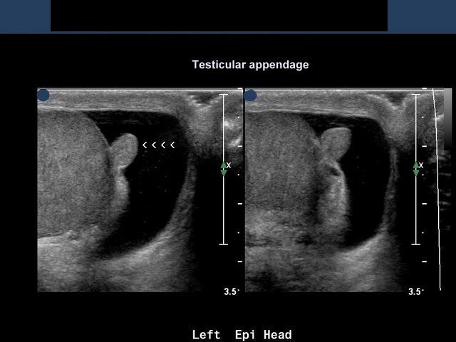 Testicular Cancer Ultrasound