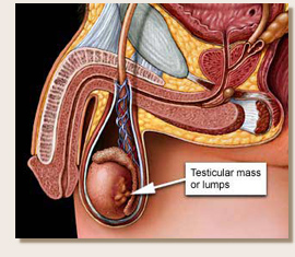 Testis Cancer