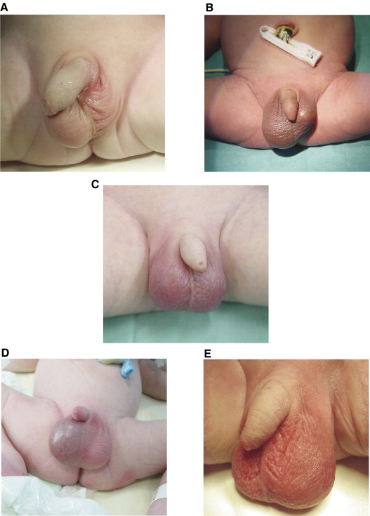 Testis Pain Left Side